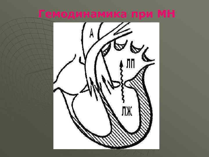 Гемодинамика при МН 