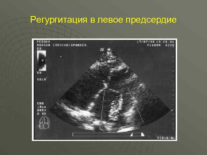 Регургитация в левое предсердие 