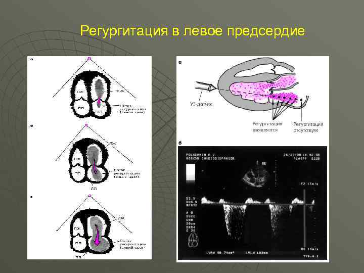 Регургитация в левое предсердие 