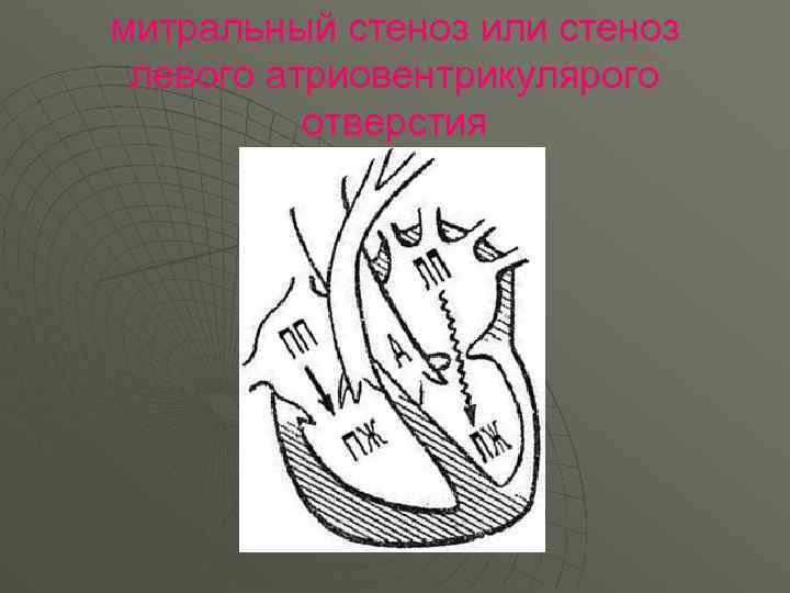 митральный стеноз или стеноз левого атриовентрикулярого отверстия 