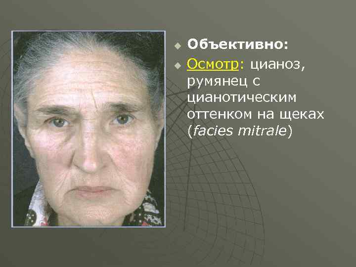 u u Объективно: Осмотр: цианоз, румянец с цианотическим оттенком на щеках (facies mitrale) 