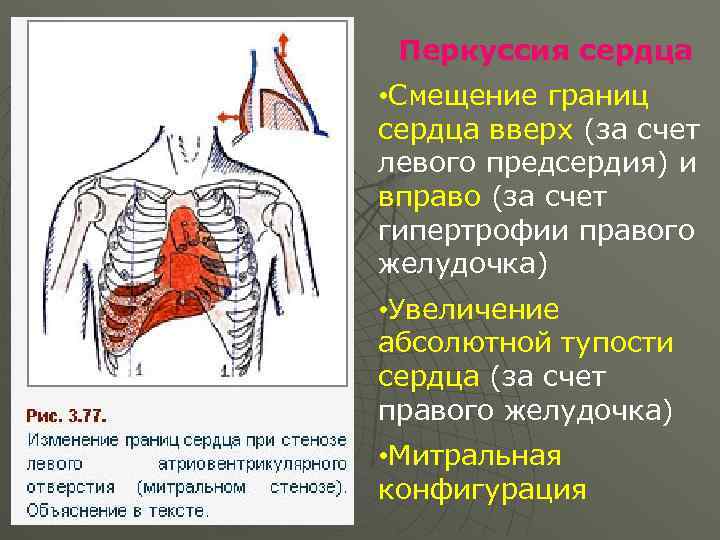 Перкуссия сердца • Смещение границ сердца вверх (за счет левого предсердия) и вправо (за