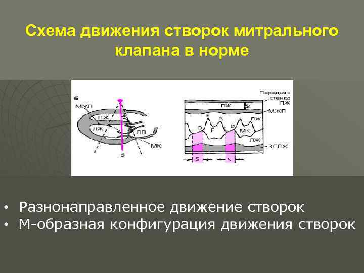 Схема движения створок митрального клапана в норме • Разнонаправленное движение створок • М-образная конфигурация