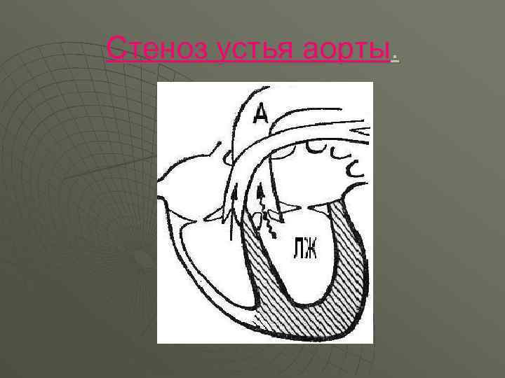 Стеноз устья аорты. 