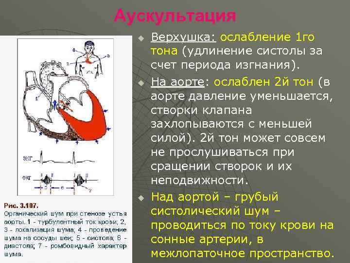 Аускультация u u u Верхушка: ослабление 1 го тона (удлинение систолы за счет периода