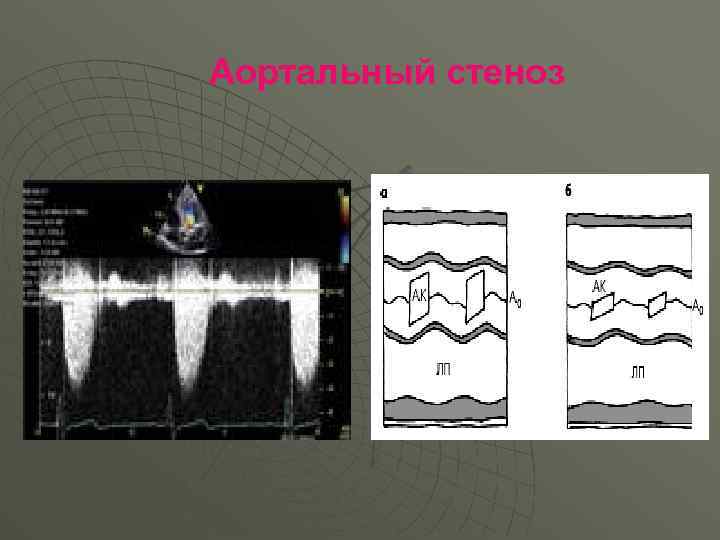 Аортальный стеноз 