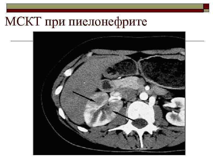 МСКТ при пиелонефрите 