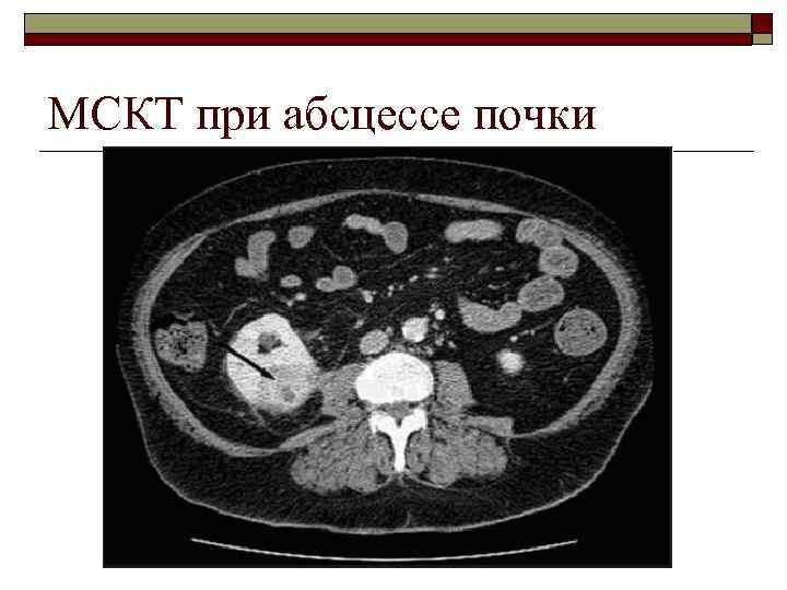 МСКТ при абсцессе почки 