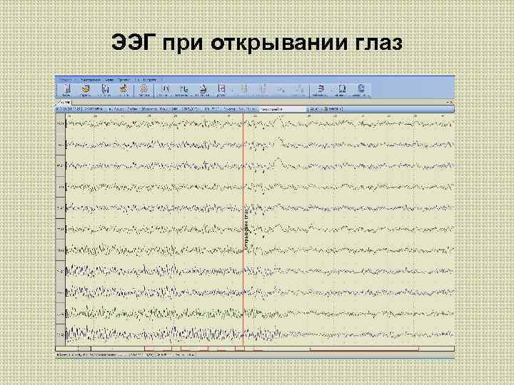 ЭЭГ при открывании глаз 