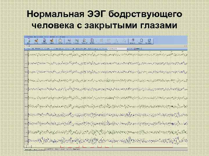 Нормальная ЭЭГ бодрствующего человека с закрытыми глазами 