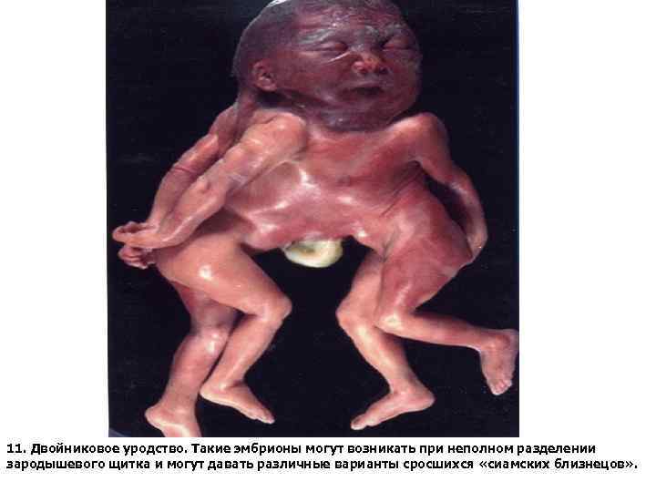 11. Двойниковое уродство. Такие эмбрионы могут возникать при неполном разделении зародышевого щитка и могут