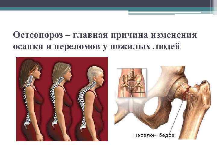 Остеопороз – главная причина изменения осанки и переломов у пожилых людей 