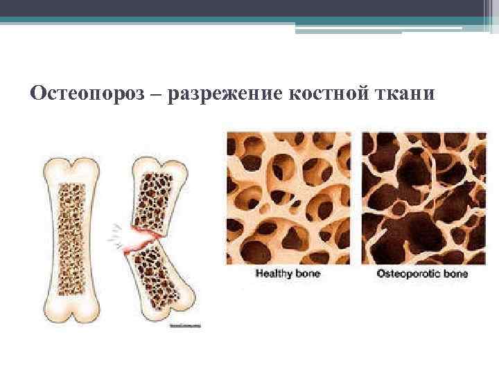 Остеопороз – разрежение костной ткани 