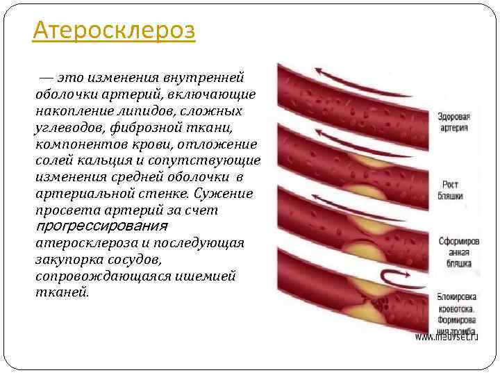 Атеросклероз — это изменения внутренней оболочки артерий, включающие накопление липидов, сложных углеводов, фиброзной ткани,