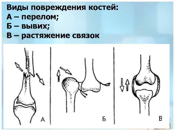 Виды травм в картинках