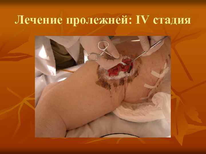 Лечение пролежней: IV стадия 