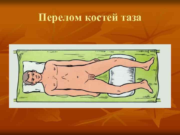 Перелом костей таза 