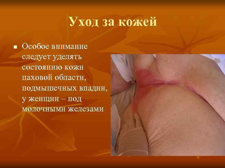 Уход за кожей n Особое внимание следует уделять состоянию кожи паховой области, подмышечных впадин,