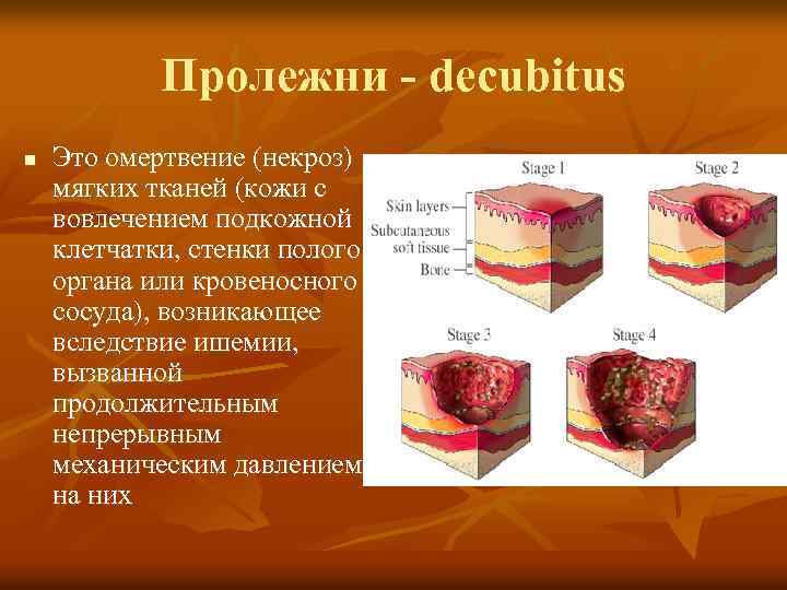 Пролежни - decubitus n Это омертвение (некроз) мягких тканей (кожи с вовлечением подкожной клетчатки,