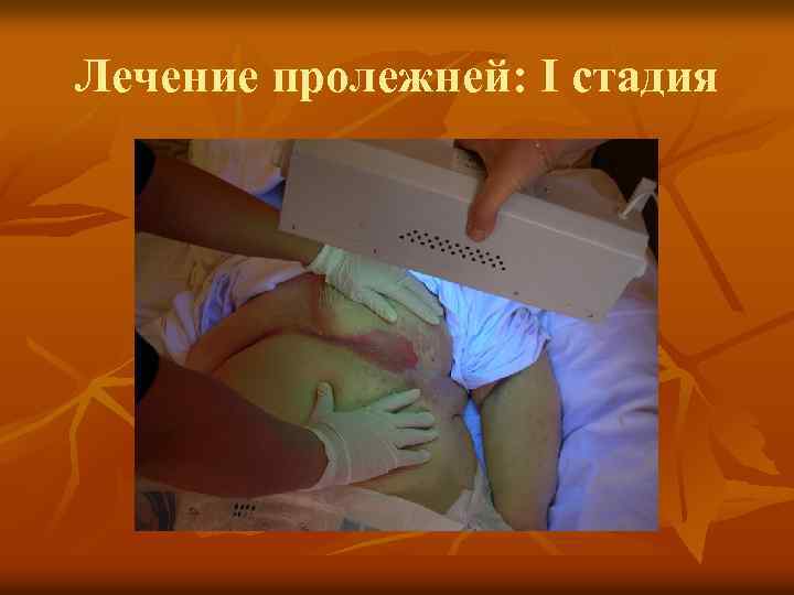 Лечение пролежней: I стадия 