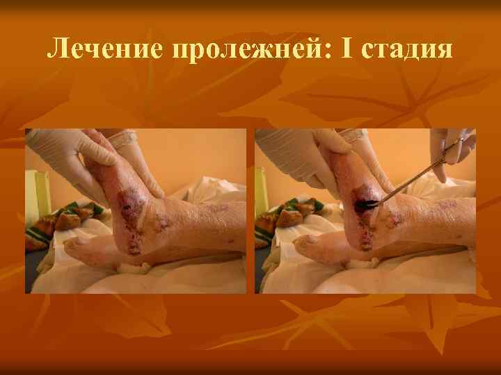 Лечение пролежней: I стадия 