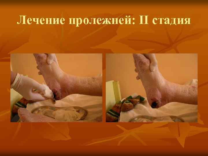 Лечение пролежней: II стадия 