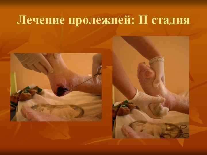 Лечение пролежней: II стадия 