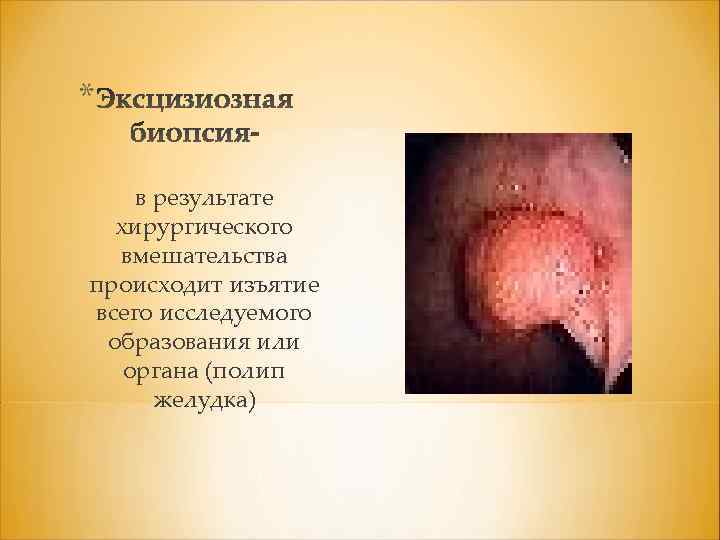 * в результате хирургического вмешательства происходит изъятие всего исследуемого образования или органа (полип желудка)