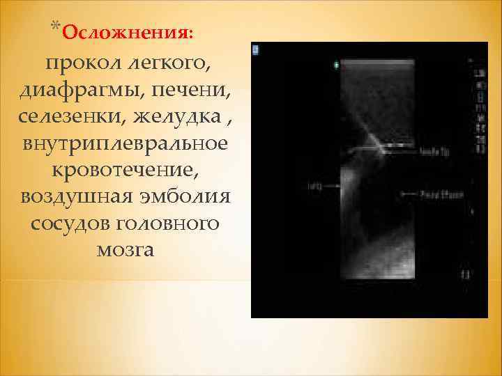 *Осложнения: прокол легкого, диафрагмы, печени, селезенки, желудка , внутриплевральное кровотечение, воздушная эмболия сосудов головного