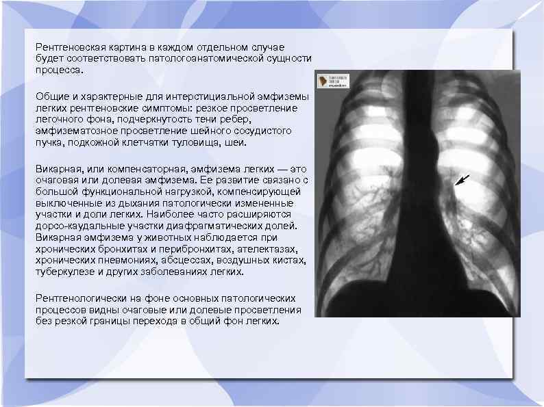 Каждом отдельном случае. Рентген при эмфиземе легких. Рентгенологические признаки эмфиземы легких. Эмфизема лёгких симптомы рентген. Рентгенография при эмфиземе легких.