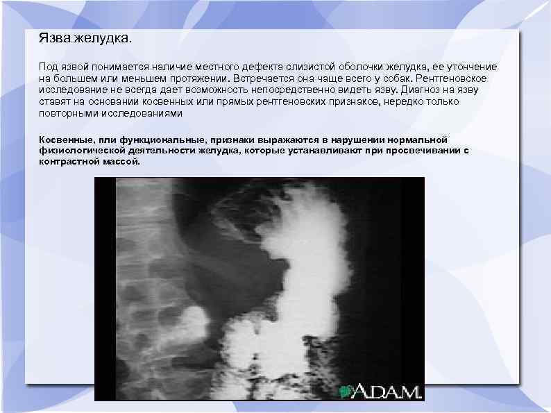 Язва желудка. Под язвой понимается наличие местного дефекта слизистой оболочки желудка, ее утончение на