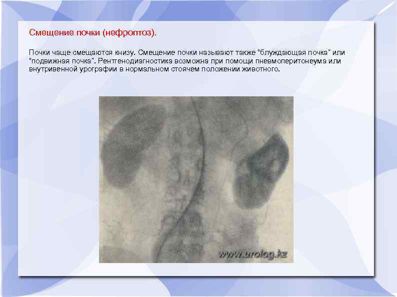 Смещение почки (нефроптоз). Почки чаще смещаются книзу. Смещение почки называют также “блуждающая почка” или