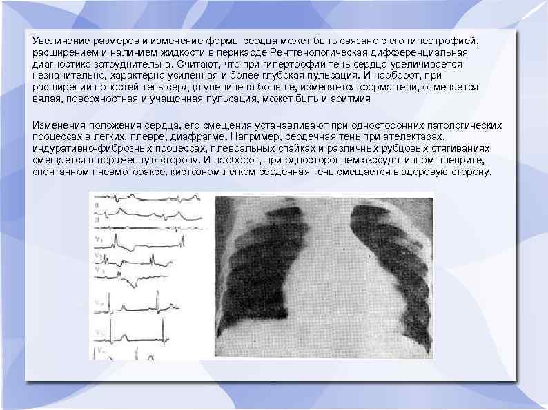Увеличение размеров и изменение формы сердца может быть связано с его гипертрофией, расширением и