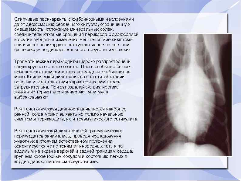 Слипчивые перикардиты с фибринозными наслоениями дают деформацию сердечного силуэта, ограниченную смещаемость, отложение минеральных солей,