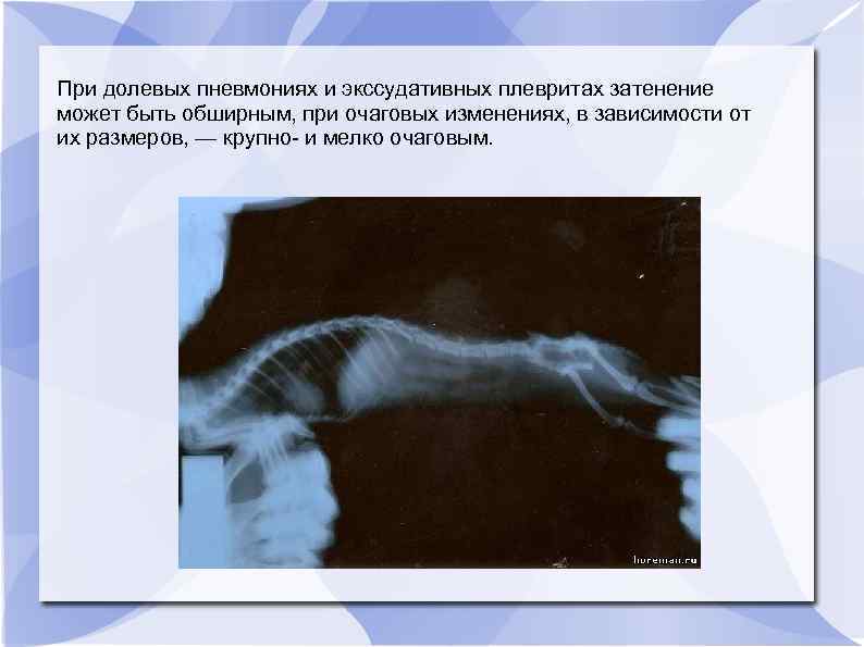 При долевых пневмониях и экссудативных плевритах затенение может быть обширным, при очаговых изменениях, в