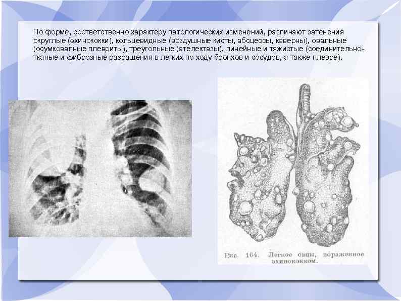 По форме, соответственно характеру патологических изменений, различают затенения округлые (эхинококки), кольцевидные (воздушные кисты, абсцессы,