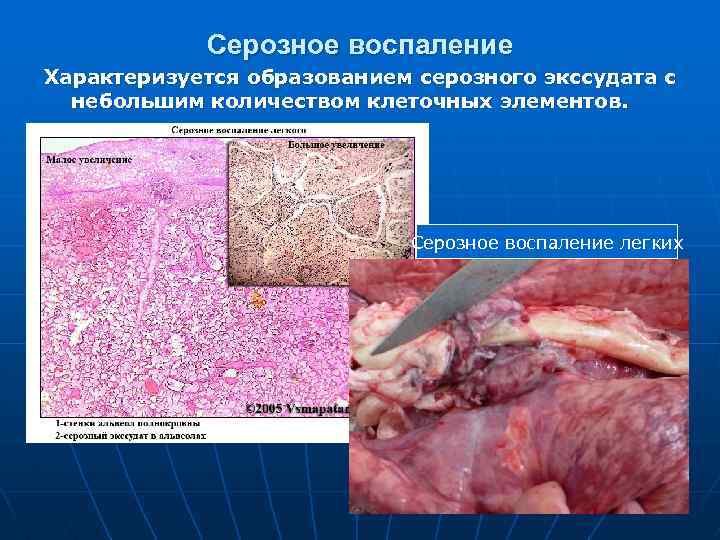 Серозное воспаление Характеризуется образованием серозного экссудата с небольшим количеством клеточных элементов. Серозное воспаление легких