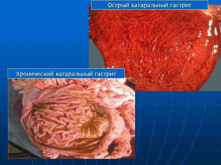 Острый катаральный гастрит Хронический катаральный гастрит 