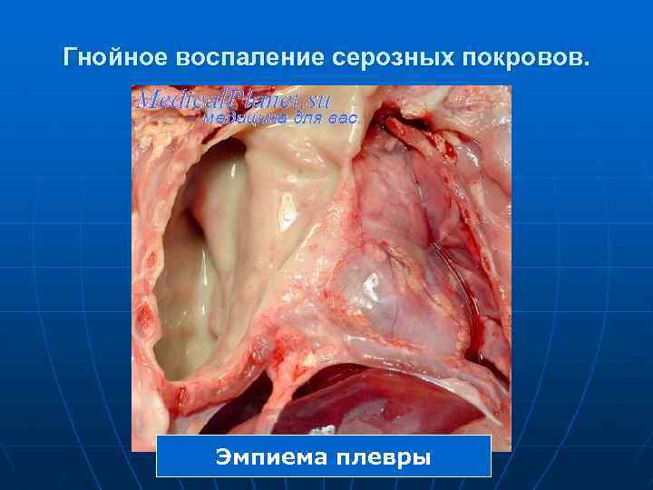 Гнойное воспаление серозных покровов. Эмпиема плевры 