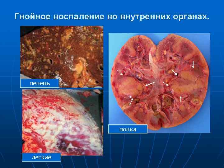 Гнойное воспаление во внутренних органах. печень почка легкие 