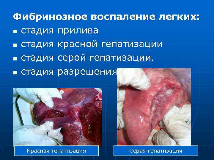 Фибринозное воспаление легких: n стадия прилива n стадия красной гепатизации n стадия серой гепатизации.