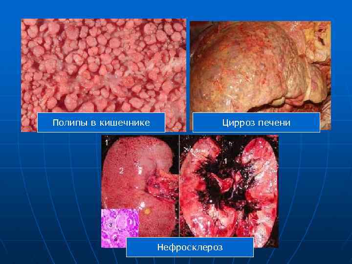 Полипы в кишечнике Цирроз печени Нефросклероз 