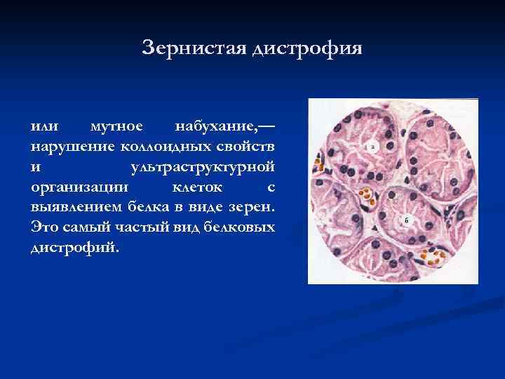 Зернистая дистрофия или мутное набухание, — нарушение коллоидных свойств и ультраструктурной организации клеток с