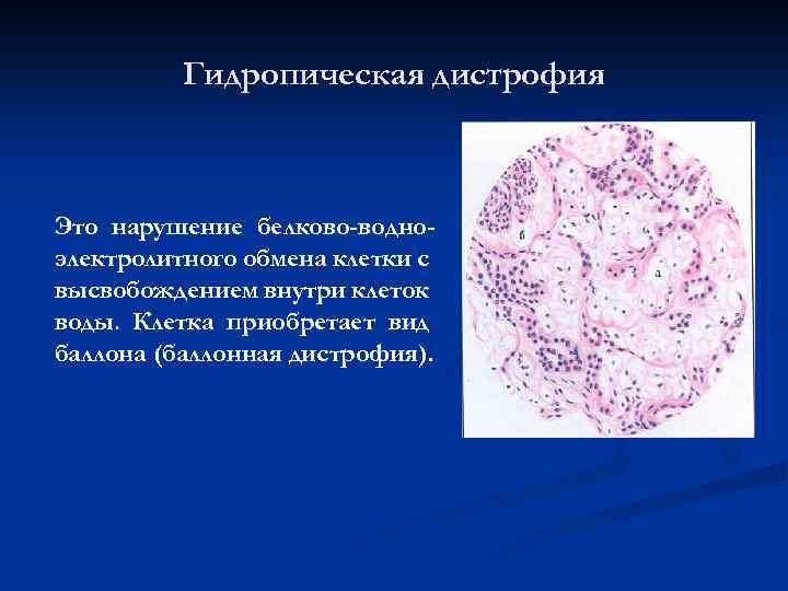 Гидропическая дистрофия Это нарушение белково-водноэлектролитного обмена клетки с высвобождением внутри клеток воды. Клетка приобретает