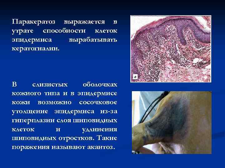 Паракератоз выражается в утрате способности клеток эпидермиса вырабатывать кератогиалин. В слизистых оболочках кожного типа