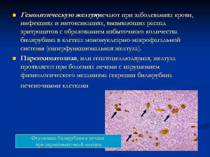 n n Гемолитическую желтуху отмечают при заболеваниях крови, инфекциях и интоксикациях, вызывающих распад эритроцитов