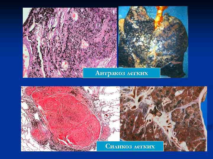 Антракоз легких Силикоз легких 