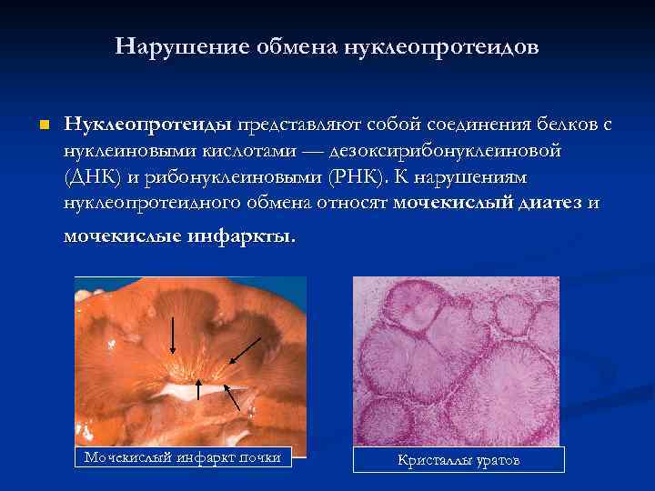 Нарушение обмена нуклеопротеидов n Нуклеопротеиды представляют собой соединения белков с нуклеиновыми кислотами — дезоксирибонуклеиновой