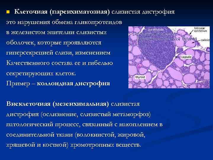 Клеточная (паренхиматозная) слизистая дистрофия это нарушения обмена гликопротеидов в железистом эпителии слизистых оболочек, которые