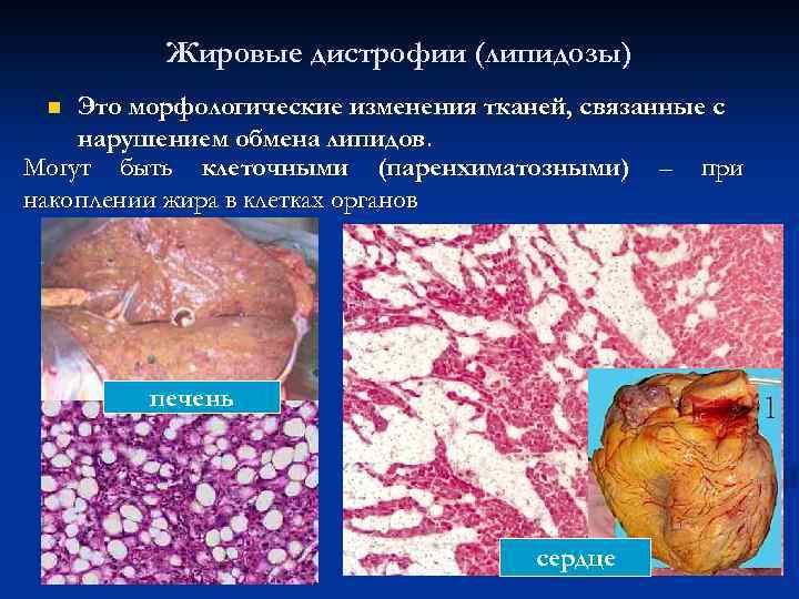 Жировые дистрофии (липидозы) Это морфологические изменения тканей, связанные с нарушением обмена липидов. Могут быть